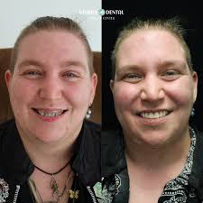 Eating with implants: does comfort improve over time?