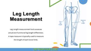 Image result for Functional Leg Length Discrepancy
