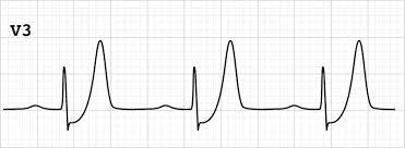 Tutorial site on clinical electrocardiography (ecg). De Winter T Wave Litfl Ecg Library Diagnosis