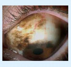 Image result for melanosis sclera
