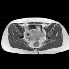 Image result for corpus luteum sonography)