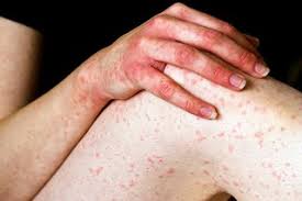 Image result for allergy rash on the legs