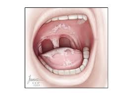 Thrush Causes Symptoms Diagnosis Treatments Prevention