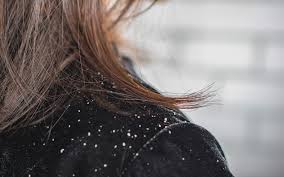 If you often pull your hair tightly into a bun, cornrows, or another hairstyle, you can develop permanent hair loss. Can Dandruff Lead To Hair Loss The Link Causes And Treatments