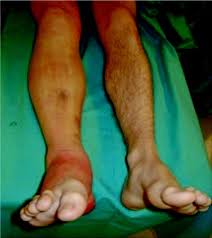 Image result for Compartment Syndrome