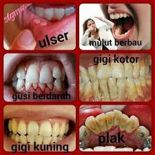 Jika sakit gigi belum mencapai tahap kritikal, anda boleh cuba beberapa cara rawatan secara alami atau tradisional yang boleh meredakan sakit gigi sebelum berjumpa dengan dentist. Gusi Bengkak Berdarah Sakit Ubat Gigi Marine Essence Facebook