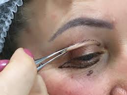 Blefaroplastia, a cirurgia das p&aacute;lpebras &ndash; Cl&iacute;nica Dra. Melissa Krindges -  Farroupilha