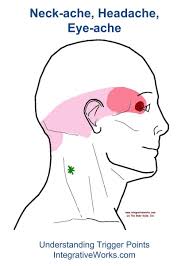 Neck Ache Headache Eye Ache Integrative Works Trigger Points Neck Ache Trigger Points Neck