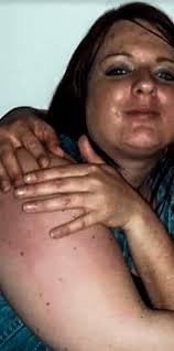 Agonising ovary condition made me feel suicidal