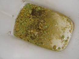 Pin On Liver Gall Stones
