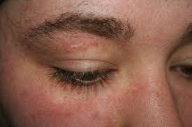 Get rid of any pressure or friction on the blistered site. Every Time I Vomit For Any Reason At All My Face Gets Super Blotchy For Some Reason For The Next Few Days Any Way To Make It Go Away Other Than Just