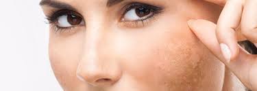 3 enfermedades de la piel en la cara más comunes - Blog ...