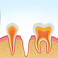 Since the clot no longer covers the cavity in the absence of the tooth, the bone and nerves are exposed. Dry Sockets Gold Coast Qld Gum Disease Gold Coast Qld