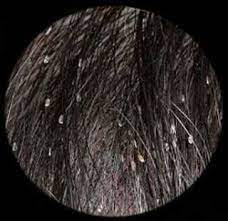 treating head lice in afro hair afro hairstyles head louse louse
