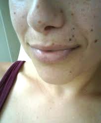 These usually appear in areas . Parkerj On Twitter Face Full Of Beauty Marks Gettinglippywithit