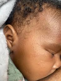 My 2 month old has this rash all over her face, it keeps getting worse by  the day. What can I use to make it go away 😕