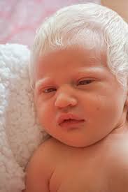 A black couple told yesterday of their shock and mystification when their son was born with white skin and blond hair. Our Baby Had A Head Full Of Hair White As Snow Mom S Shocked Reaction To Albino Newborn Love What Matters