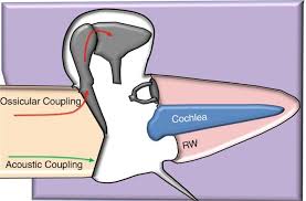 Image result for Ossicular Chain Disruption