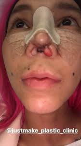 Before having plastic surgery, you should have a consultation with a plastic surgeon. Facebook