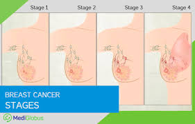 Stage 4 breast cancer cancer, also known as secondary breast cancer , can be any size, the lymph nodes may or may not contain cancer, but the cancer has spread (metastasised) to other parts of the body, such as distant lymph nodes, lungs, bones, liver or brain. Stages Of Breast Cancer Mediglobus