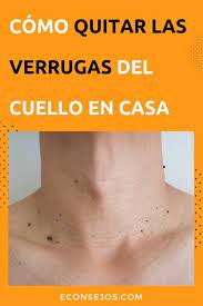 Quitar Las Verrugas Del Cuello Conozca Los Mejores Ingredientes Naturales Para Eliminar Con Imagenes Como Quitar Verrugas Remedios Para Verrugas Como Eliminar Las Verrugas