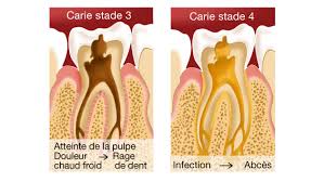 Sous l'effet de divers facteurs, certaines bactéries se développent et transforment les résidus alimentaires en acides qui rongent les tissus de la dent. Caries Et Soins Des Caries