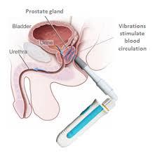 Prostate massage can have benefits, including treatment and prevention of prostatitis and erectile dysfunction, as well as improved urine flow. Internal Prostate Massage Techniques To Recover Your Prostate Health
