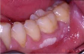 Your symptoms, even if they seem unrelated to your condition. Leukoplakia White Patch On Gums Causes And Treatment