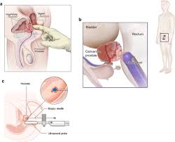 Image result for Expressed Prostatic Secretion
