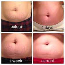Bio Oil White Stretch Marks Before And After Pin On Beauty And Essential Oils