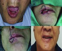 Image result for Lip Cancer