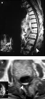 Spinal Epidural Hematoma Associated With Streptokinase Treatment For Myocardial Infarction Spinal Cord