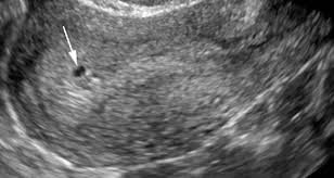 În timpul menstruației, leziunile endometriotice sunt formațiuni de sângerare. Ecografia In Primele 12 Saptamani De Sarcina Pentru Sangerari Vaginale Crampe Sau Dureri De Burta
