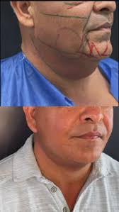 𝐑𝐞𝐣𝐮𝐯𝐞𝐧𝐞𝐜𝐢𝐦𝐢𝐞𝐧𝐭𝐨 𝐟𝐚𝐜𝐢𝐚𝐥 𝐦𝐚𝐬𝐜𝐮𝐥𝐢𝐧𝐨 , 2  semanas postop 🇺🇸, Caso retador en hombre con alopecia, que obliga a no  extender las cicatrices y acortarlas aún más pese al gran colgajo de cuello  para ...