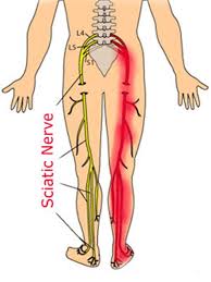 Pin On Sciatica