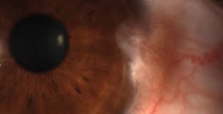 Image result for lesion sclera