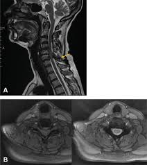 SciELO Brasil - Cervical Myelopathy Secondary to Gout: Case Report Cervical  Myelopathy Secondary to Gout: Case Report