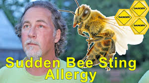 You should also seek medical help if you have a known allergy to bee stings or if you. Warning Sudden Bee Sting Allergy Signs Symptoms And Dangers Of Anaphylaxis Youtube