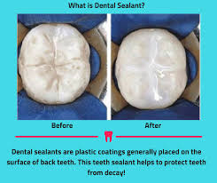 After placement of a sealant, which of the following should be checked? Dental Sealant Is A Thin Plastic Coating Painted On The Chewing Surfaces Of Teeth Usually The Back Teeth The Premolars And Dental Sealants Dental Dental Fun
