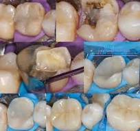El paso a paso de una incrustación dental✨ - Restauración ...