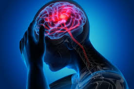 Aneurisma otak yang tak kunjung ditangani bisa menyebabkan stroke sampai mengancam jiwa. Mengenal Sebab Dan Gejala Aneurisma Otak Yang Dialami Dr Dre