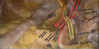 This atlas will allow gynaecologic surgeons to deepen and improve their anatomical expertise, with the aid of laparoscopy. Laparoscopic Surgical Anatomy For Pelvic Floor Surgery Sciencedirect