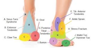 Pain on the top of foot is a common symptom of. Foot Pain Diagram Why Does My Foot Hurt