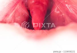 Image result for Uvulitis