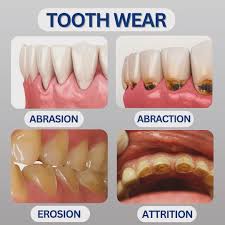 Image result for Tooth Abrasion