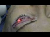 Upper Eyelid Laser Surgery - Blepharoplasty - YouTube