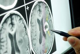 Other primary brain tumors include lymphosarcoma (lsa), pituitary tumors, gliomas, ependymoma, choroid plexus papilloma, medulloblastoma, olfactory neuroblastoma, and gangliocytoma. Can A Tetanus Shot Help Fight Brain Tumors News Blog National Brain Tumor Society