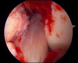 The anterior cruciate ligament (acl) is one of a pair of ligaments in the center of the knee joint that form a cross, and this is where the name cruciate comes from. Acl Reconstruction Surgery Faq