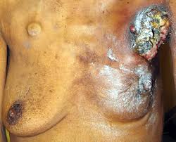 Don't panic if you have signs or symptoms like fatigue, weight change or bone pain. Breast Cancer Wikipedia