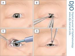 Image result for Coloboma